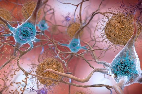 Illustration of Alzheimer’s disease showing neurons with blue cell bodies and brown clumps of amyloid plaques and tangled fibers.