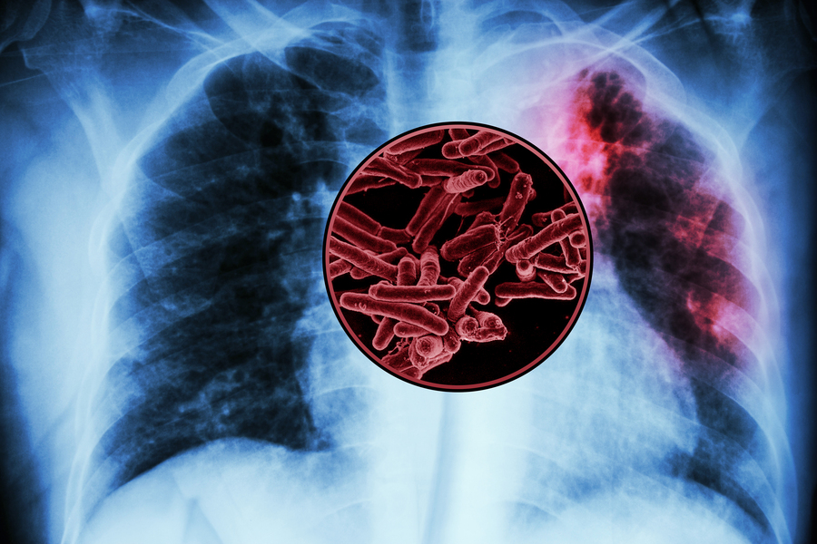 Tuberculosis-infected lungs with a close-up of tuberculosis bacteria.